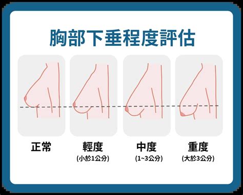布袋奶怎麼救 胸部下垂特徵區分示意圖